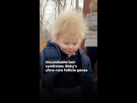 Baby Lock's hair isn't styled, it's a rare condition #uncombablehairsyndrome 1
