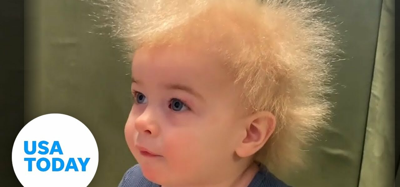 Uncombable hair syndrome: Baby's ultra-rare follicle genes 1
