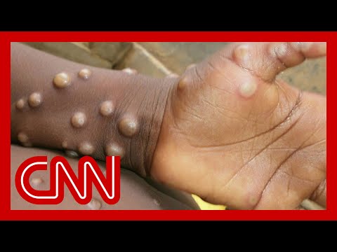 Monkeypox - how does it spread and what are the symptoms? 1