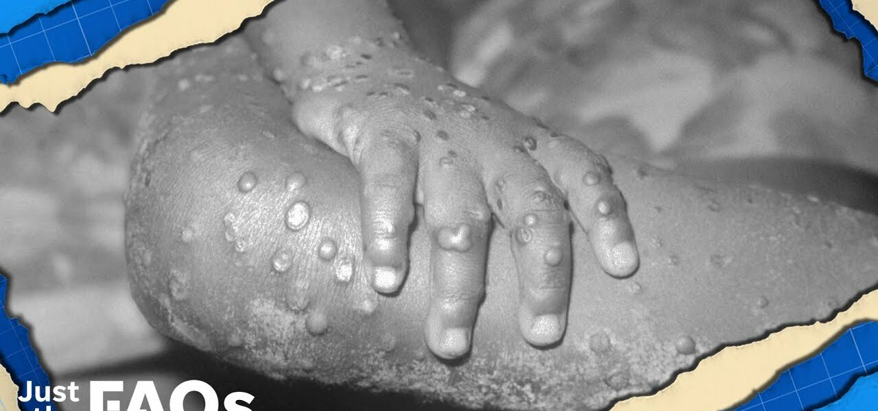 Here's why we shouldn't be too concerned about monkeypox | JUST THE FAQS 1