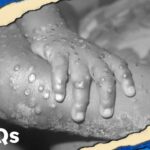 Here's why we shouldn't be too concerned about monkeypox | JUST THE FAQS 5