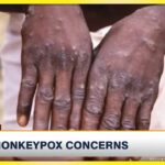 Monkeypox Disease | TVJ News - May 19 2022 8