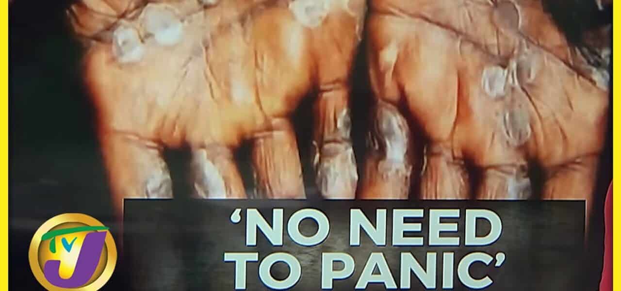 Monkeypox Update - 'No Need to Panic' | TVJ News - July 7 2022 1